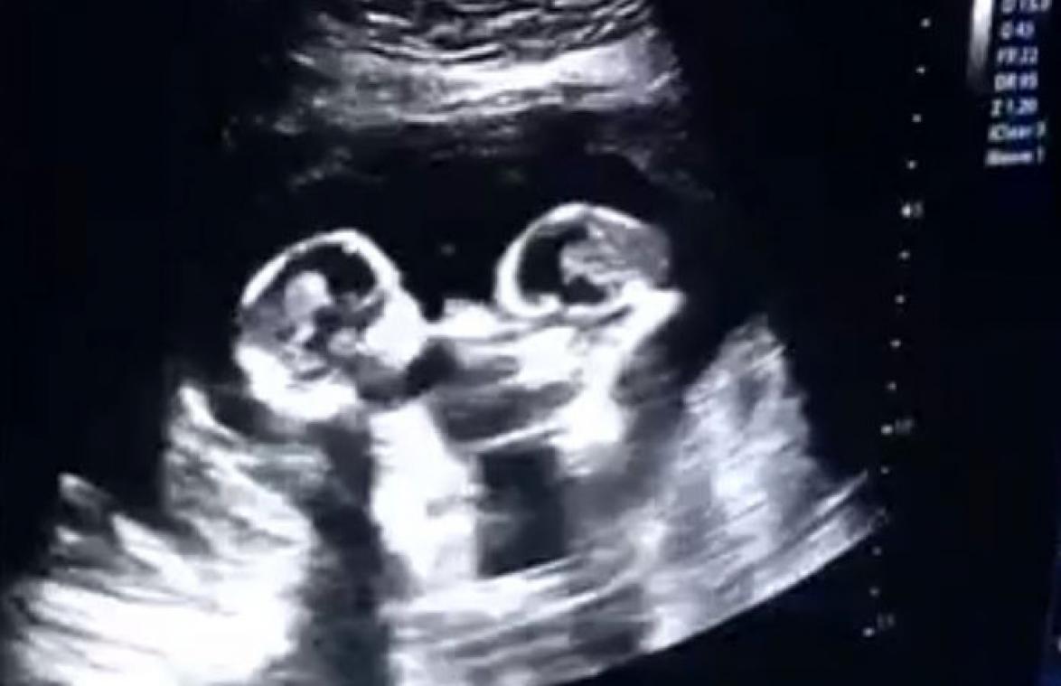 Ongeboren identieke tweeling al vechtend gespot op echo