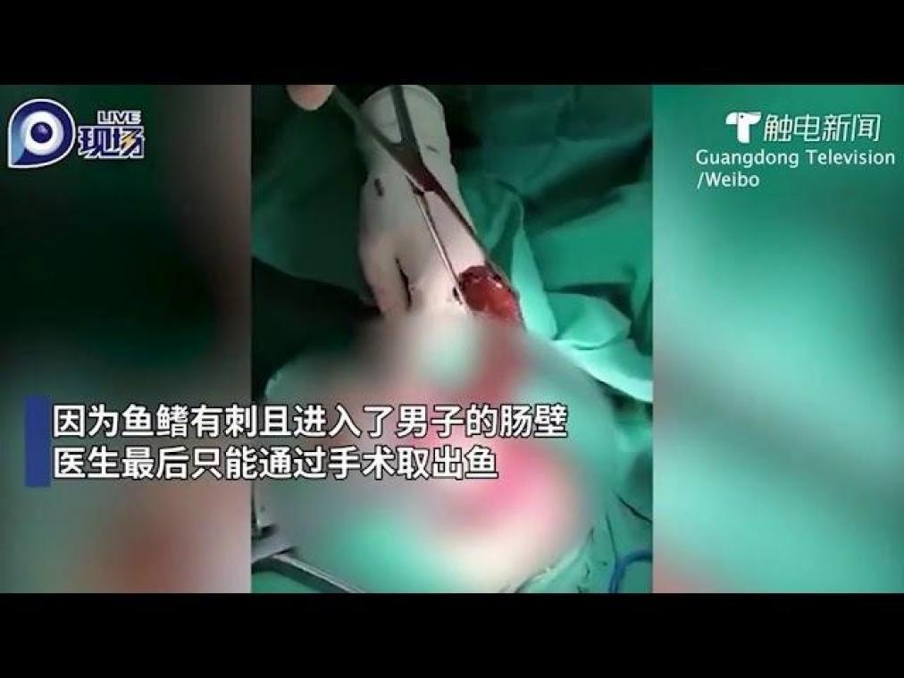 BIZAR. Artsen verwijderen vis uit rectum van man: "Per ongeluk op gaan zitten" (video)