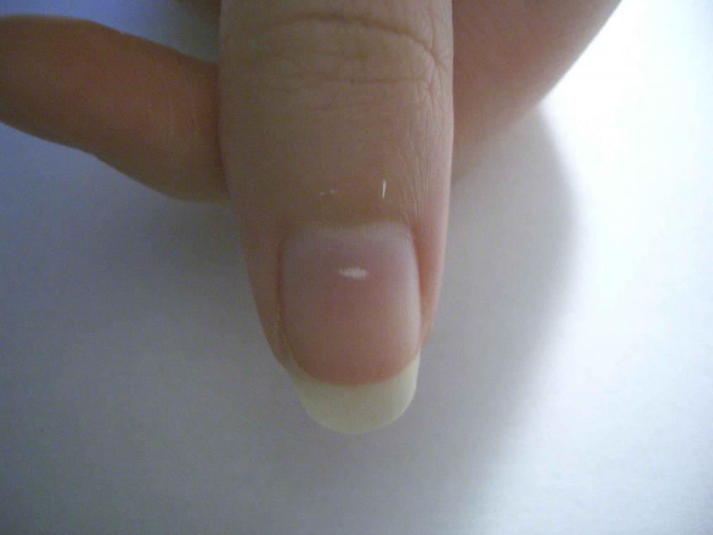 Witte vlekjes op nagels zijn onschuldige trauma's
